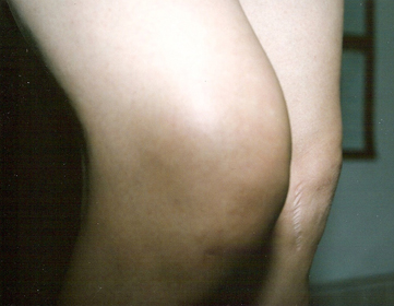 swollen-knee-2.jpg