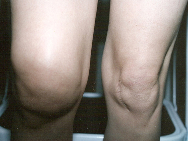 Tina's swollen knee
